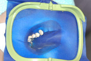 虫歯の治療　ラバーダム防湿
