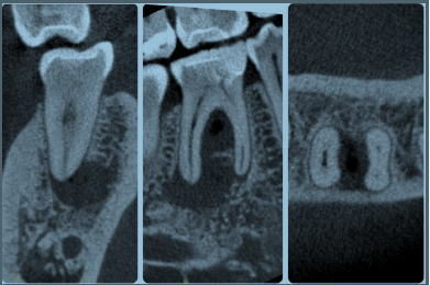 <strong>歯科用顕微鏡による根管治療</strong>