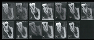 歯科用CTには2種類ある