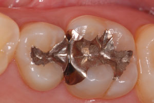 大きく削る銀歯治療