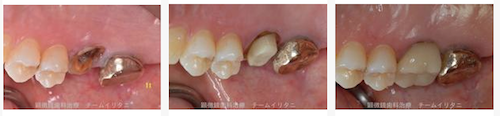 複数の歯科医が抜歯と治療方針を提示した残根症例