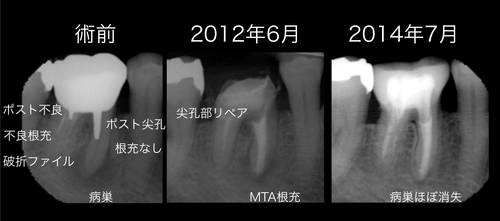 複数の歯科医が抜歯と治療方針を提示した症例
