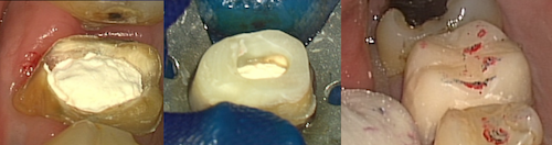 顕微鏡歯科とラバーダムと仮歯