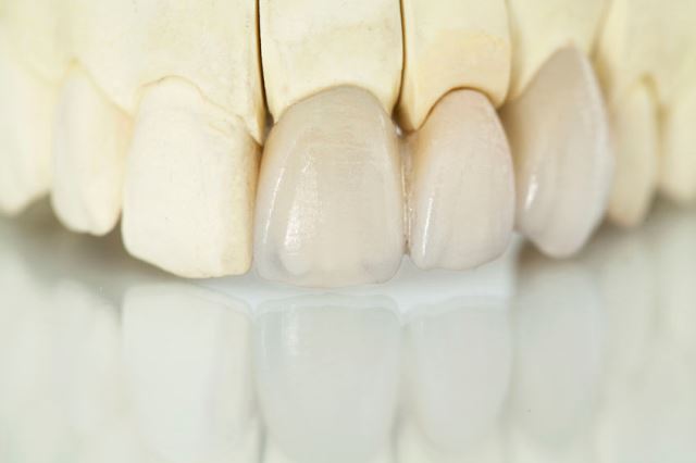 仮歯の重要性
