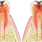 痛い虫歯と痛くない虫歯～虫歯にもステージがある？～